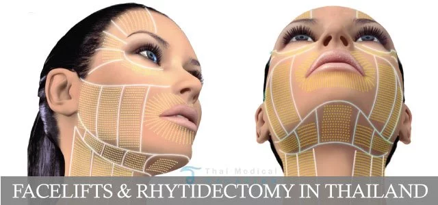 facelifts-Rhytidectomy-thailand