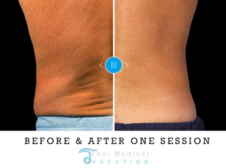 freeze-lipo-coolsculpting-dave-thailand-before-after