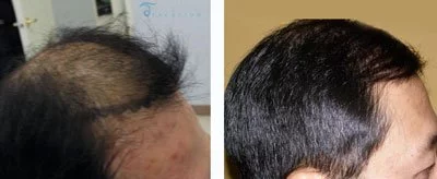 mr-kim-before-after-hair-transplant-thailand