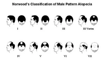norwood-classification-sytem-hair-thailand