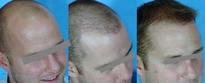 ricky-y-hair-restoration-FUE-micrografting-before-after