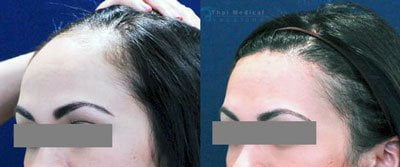 sheila-k-before-after-hairline-restoration-bangkok