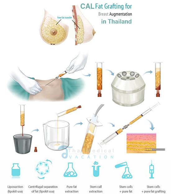stem-cell-breast-augmentation-thailand