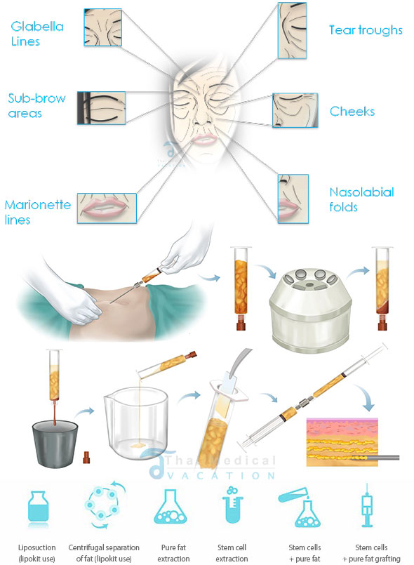 stem-cell-facelift-places-before-after-thailand