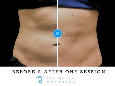 zeltiq-coolsculpting-jane-thailand-before-after