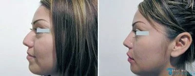 nose-job-thailand-rhinoplasty-kim-before-after