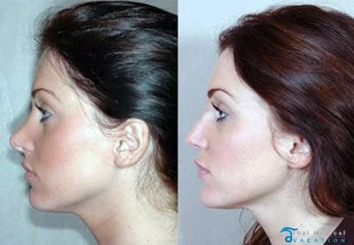 sarah-before-after-nosejob-bangkok