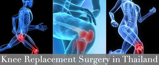 total-knee-Joint-Replacement-thailand