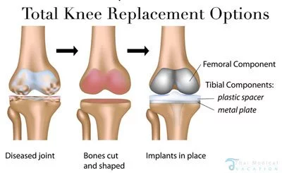 total-knee-replacement-surgery-bangkok