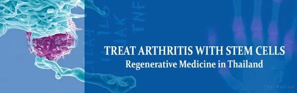 arthritis-treatment-stem-cells