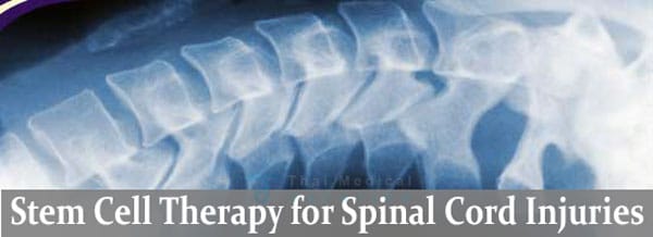 stem cell treatment for spinal cord injury stem cell treatment for spinal cord injury