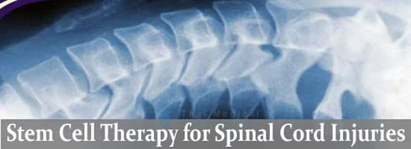 stemcell-therapy-spinal-cord-injury